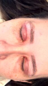 Pós-Operatório em Itu com andressa costa pos de blefaroplastia-antes