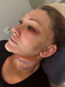 Pós-Operatório em Itu com andressa costa pos de reestruturação facial-antes