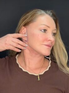 Pós-Operatório em Itu com andressa costa pos de reestruturação facial-depois