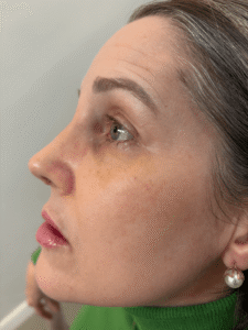 Pós-Operatório em Itu com andressa costa pos de rinoplastia-depois
