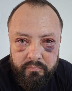 Pós-Operatório em itu com andrssa costa pós de Blefaroplastia-antes