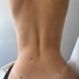 Pos Operatorio em Itu Lipoescultura depois