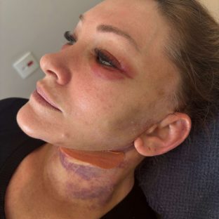Pós-Operatório em Itu com andressa costa pos de reestruturação facial-antes