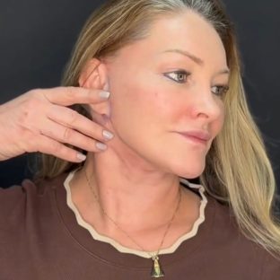 Pós-Operatório em Itu com andressa costa pos de reestruturação facial-depois