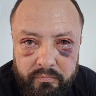 Pós-Operatório em itu com andrssa costa pós de Blefaroplastia-antes